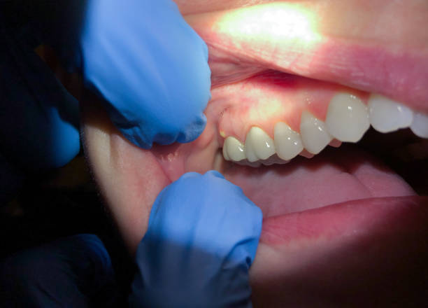 Best Broken or Chipped Tooth Repair in Wolcott, IN